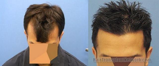 Top view of hair restoration outcome