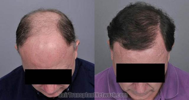 Hair transplantation surgery before and after photos