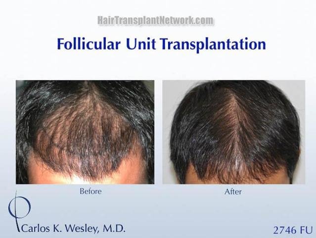 Hair transplantation surgery before and after pictures