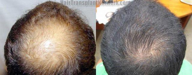 Hair restoration pictures left side views before and after