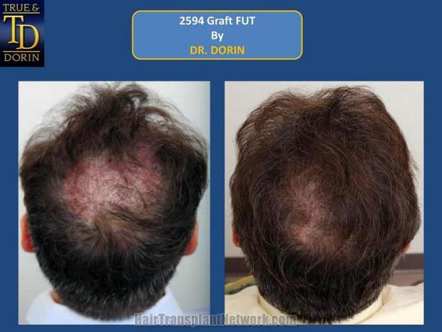 Hair transplant surgery before and after pictures