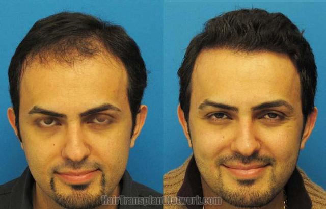 Hair restoration procedure before and after results