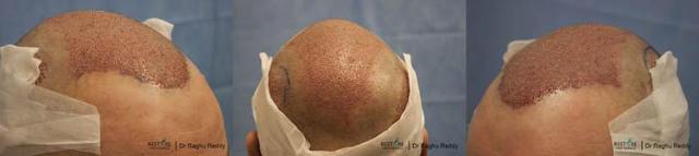 Hair restoration surgery before and after images