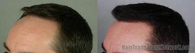 Hair transplant patient pictures viewing left side