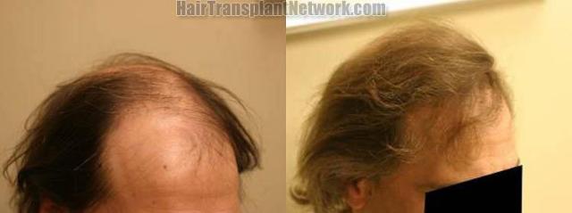 Hair restoration patient before and after images