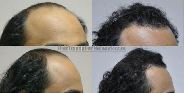 Hair restoration procedure before and after results