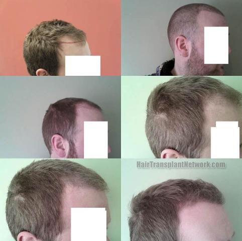 Hair transplantation surgery before and after images