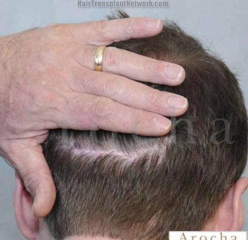 Hair transplantation surgery before and after pictures