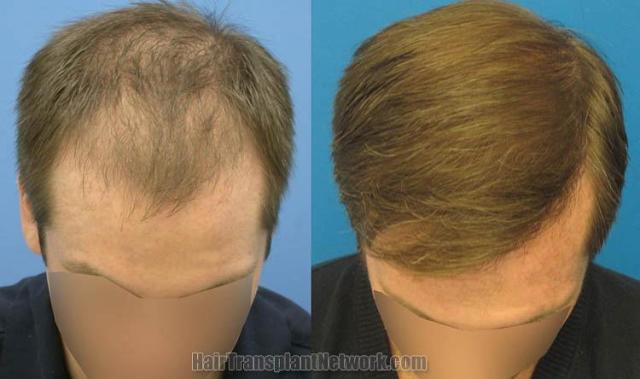 Top view before and after hair restoration results