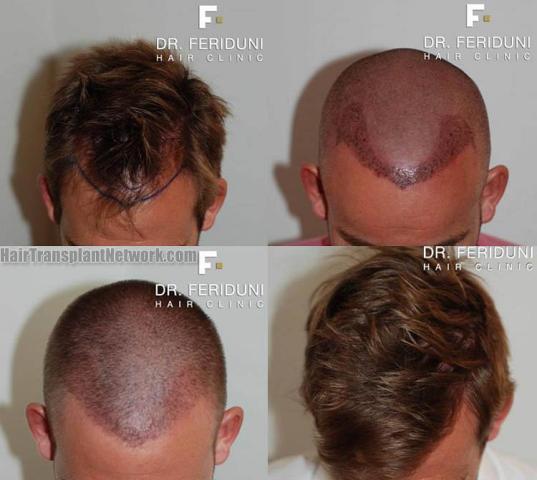 Hair restoration procedure before and after results