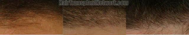 Closeup hairline views of hair transplant results