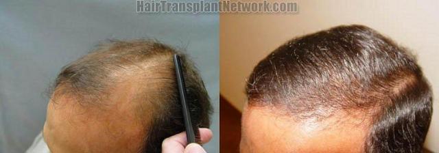 Hair restoration procedure pictures - Left view