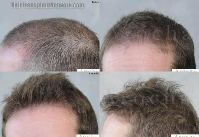 Hair transplantation surgery before and after images