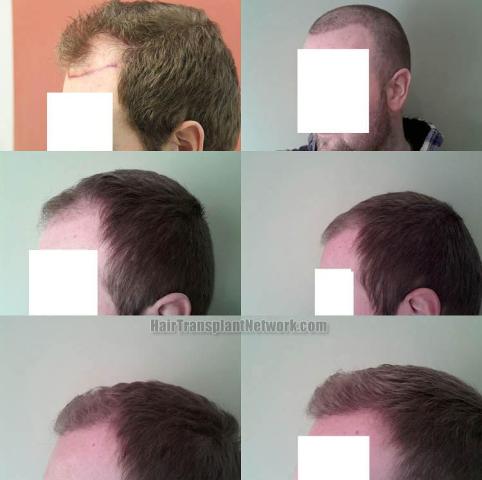 Hair restoration procedure results