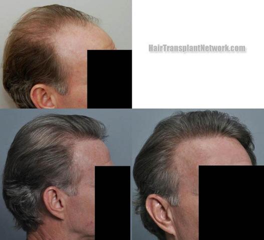 Hair transplantation surgery before and after pictures