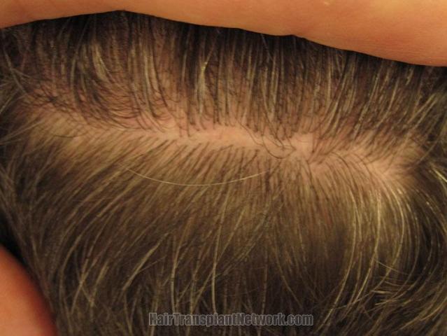 Residual donor scar area after hair transplant
