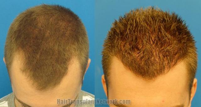 Hair transplantation surgery before and after photos