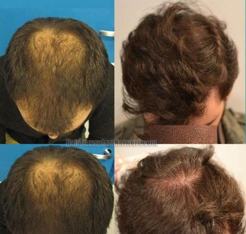 Top view - Before and after surgical hair replacement