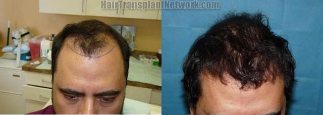 Top view before and after hair restoration procedure