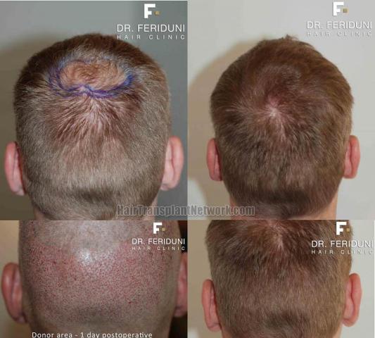 Before and after hair transplantation procedure