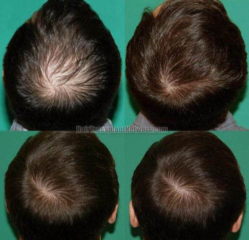 Hair restoration procedure before and after results