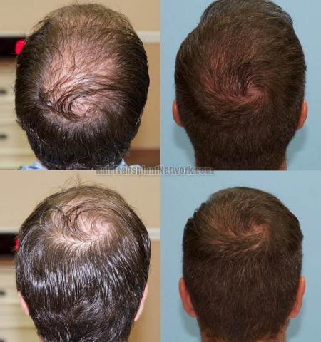 Hair replacement surgery before and after images