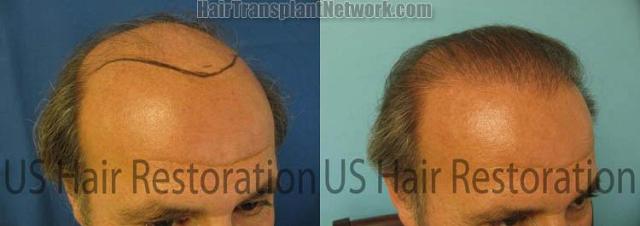 Right view before and after hair transplantation
