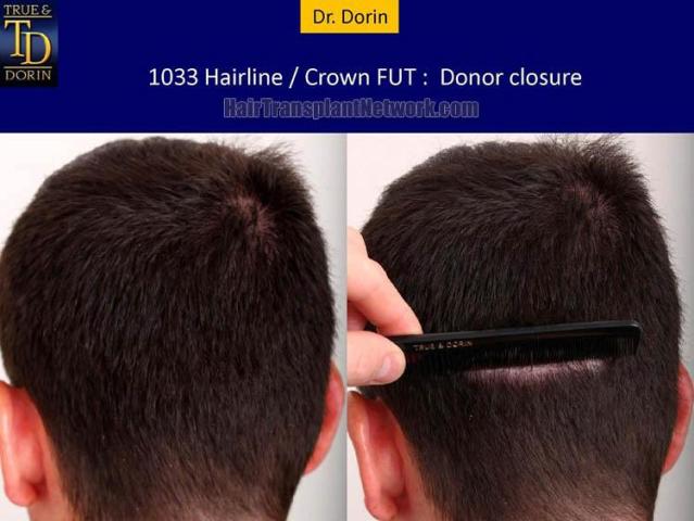 Hair transplant surgery before and after photos