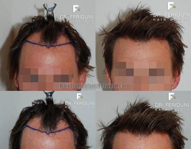 Hair restoration procedure before and after results