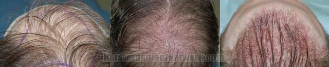 Variety of intraoperative photos from hair transplant