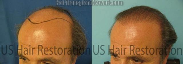Hair replacement procedure before and after photos