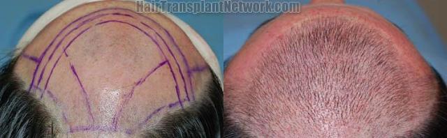 Before and immediate postoperative hair transplant