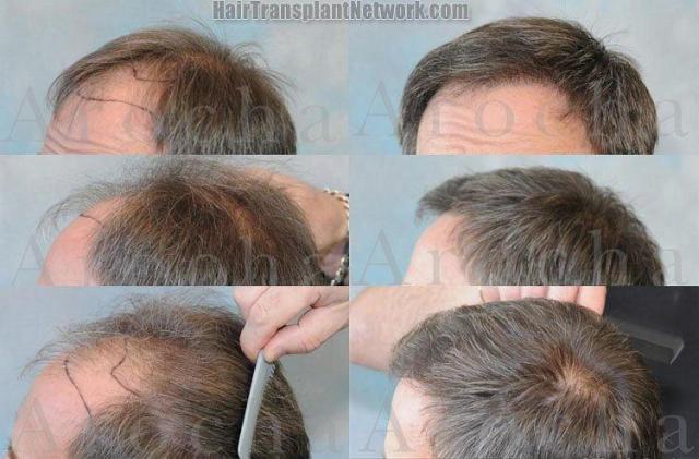 Hair restoration procedure results