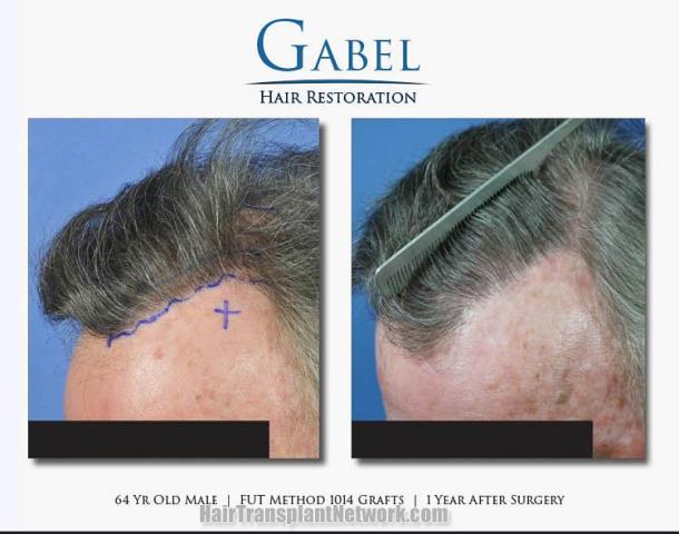 Hair restoration procedure before and after photos