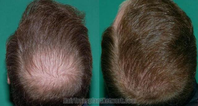 Hair restoration procedure before and after photos