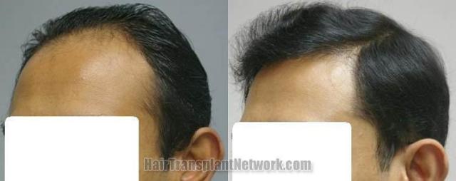 Left view before and after hair replacement results