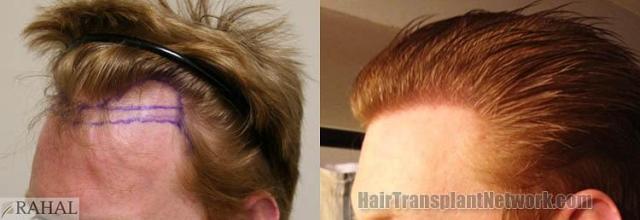 Hair transplantation surgery before and after images