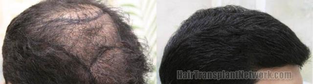 Right view before and after hair restoration images