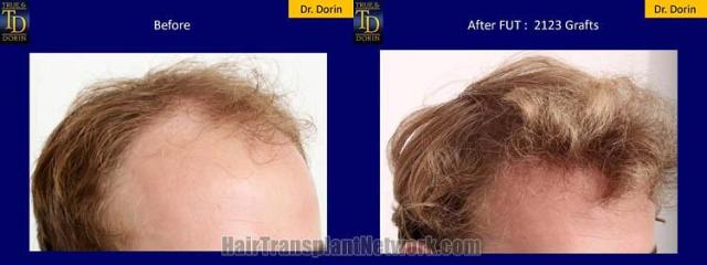 Hair transplantation surgery before and after pictures