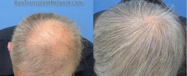 Before and after photos of  hair transplant to the crown