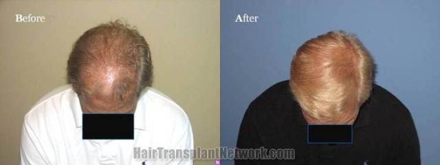 Top view before and after hair restoration