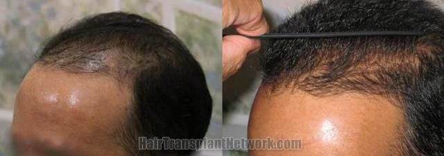 Before and after hair transplant surgical procedure