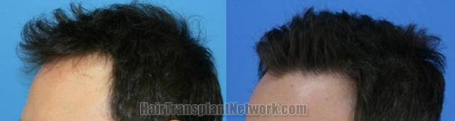 Before and after hair transplantation procedure
