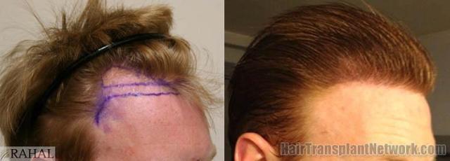 Hair transplantation surgery before and after photos