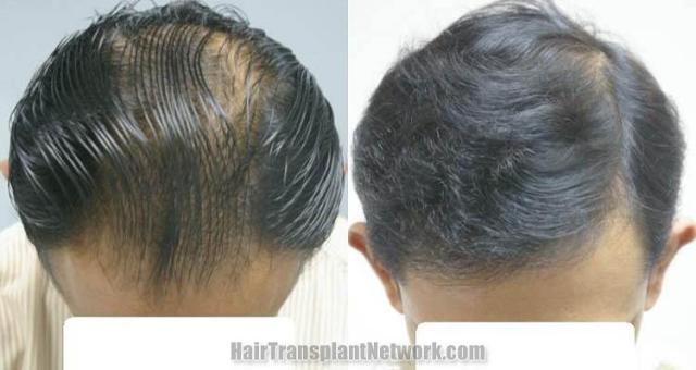 Top view before and after hair restoration procedure