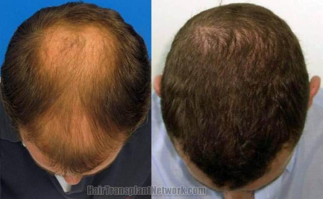 Top view before and after hair restoration results