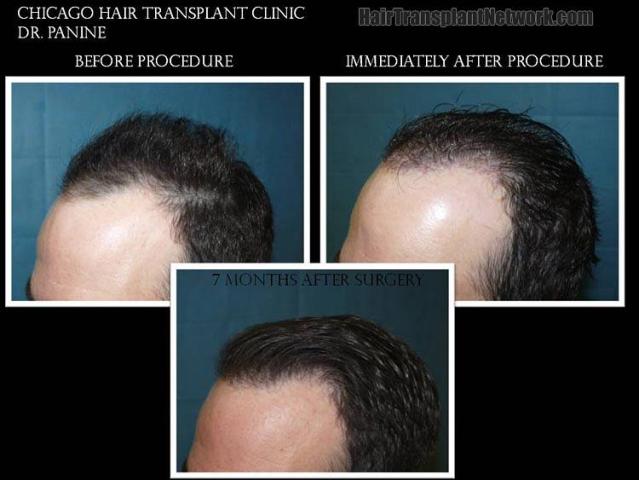 Photos showing hair restoration procedure results