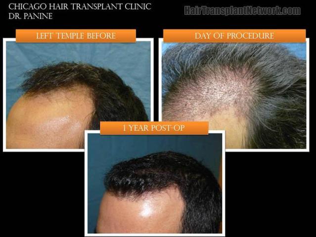 Hair transplantation surgery before and after pictures