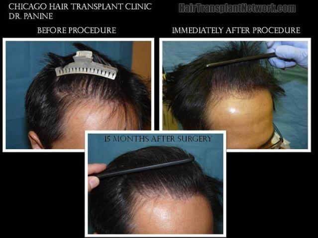 Hair transplant procedure before and after images