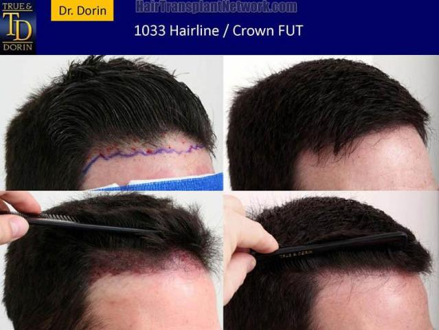 Hair restoration procedure before and after pictures